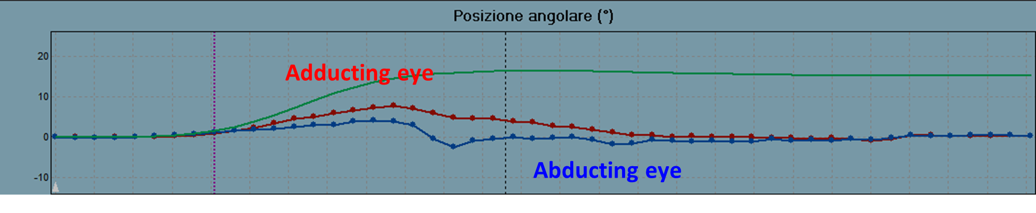 VHIT gaze position graph reduced gain